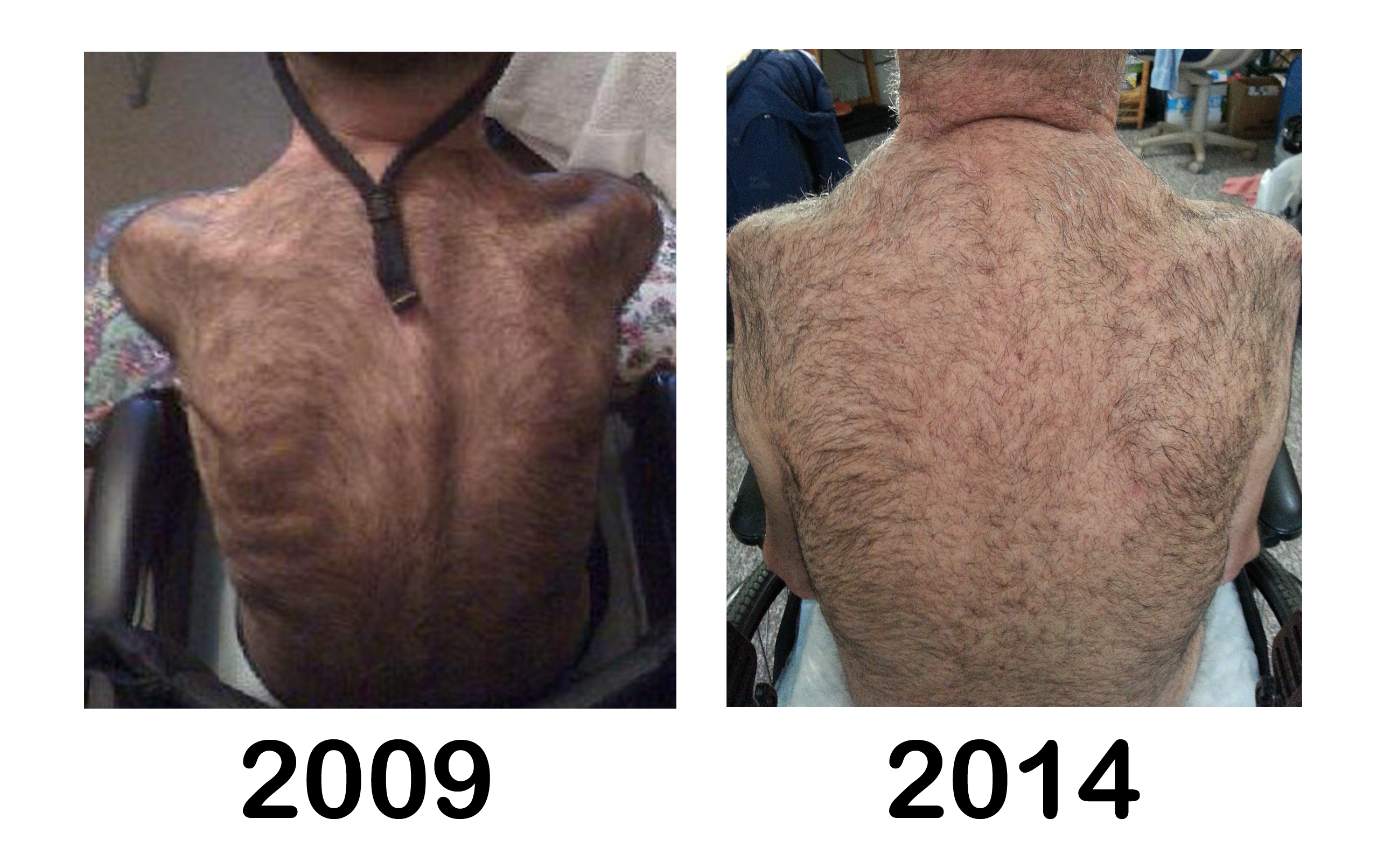 Healing ALS - MND - Lou Gehrigs Disease | Indiegogo