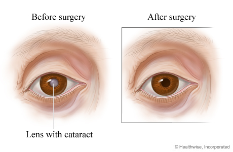 cataract surgery restoring vision with lions eye hospital honduras indiegogo cataract surgery restoring vision with lions eye hospital honduras indiegogo